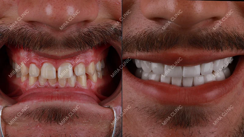 Before-and-After Results